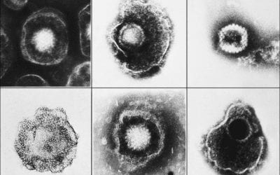 Part 2: Herpes Viruses and Migraine
