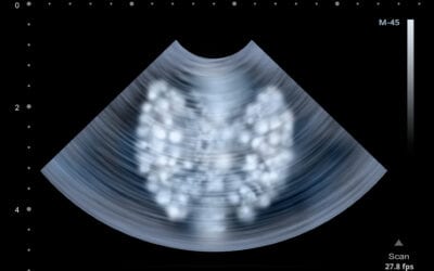 The Butterfly in Your Throat: Thyroid Hormone and Migraines